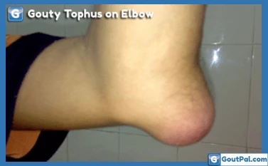 Gouty Tophus On Elbow Photograph