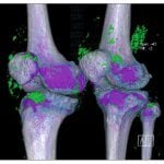 DECT of Gout in the Knees